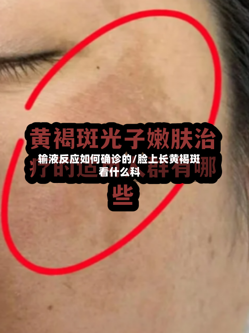输液反应如何确诊的/脸上长黄褐斑看什么科
