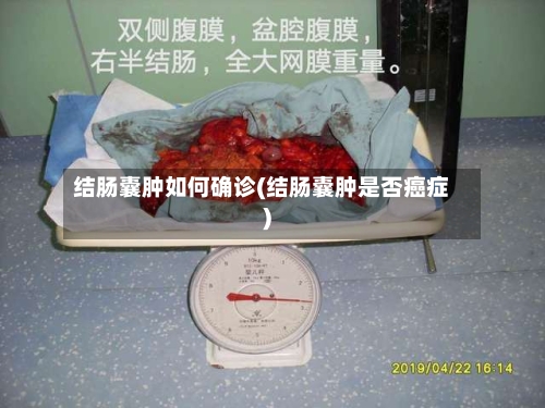 结肠囊肿如何确诊(结肠囊肿是否癌症)
