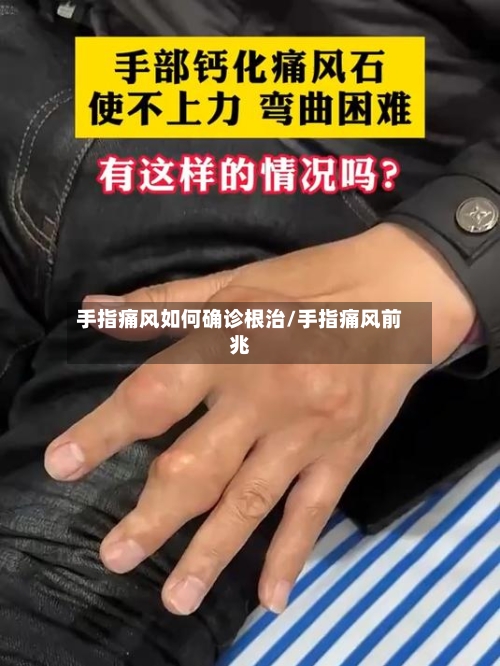 手指痛风如何确诊根治/手指痛风前兆