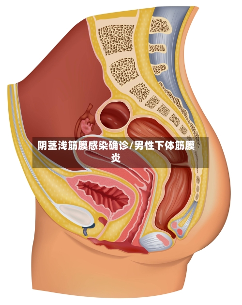 阴茎浅筋膜感染确诊/男性下体筋膜炎