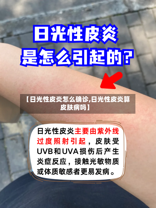【日光性皮炎怎么确诊,日光性皮炎算皮肤病吗】