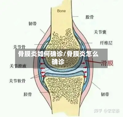 骨膜炎如何确诊/骨膜炎怎么确诊