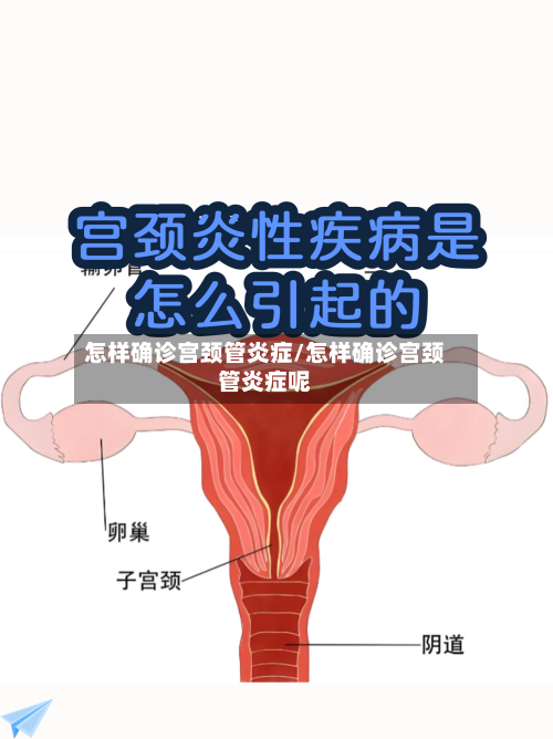 怎样确诊宫颈管炎症/怎样确诊宫颈管炎症呢