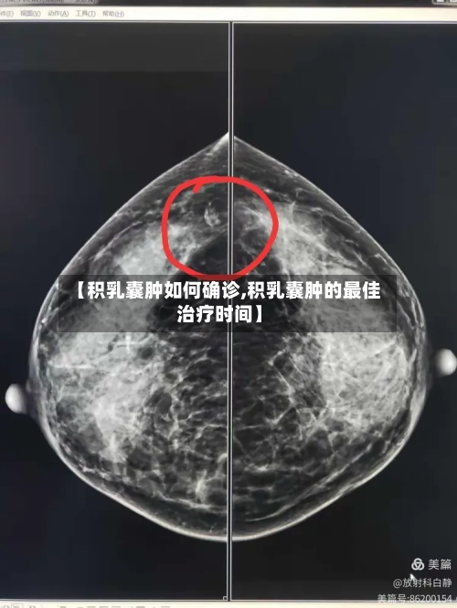 【积乳囊肿如何确诊,积乳囊肿的最佳治疗时间】
