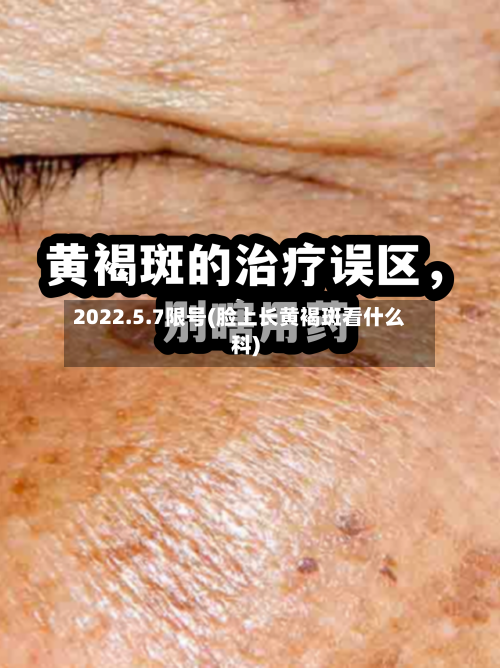 2022.5.7限号(脸上长黄褐斑看什么科)