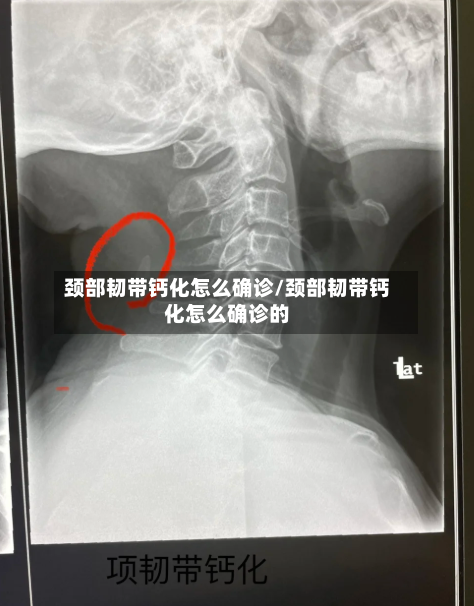 颈部韧带钙化怎么确诊/颈部韧带钙化怎么确诊的