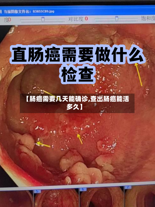 【肠癌需要几天能确诊,查出肠癌能活多久】