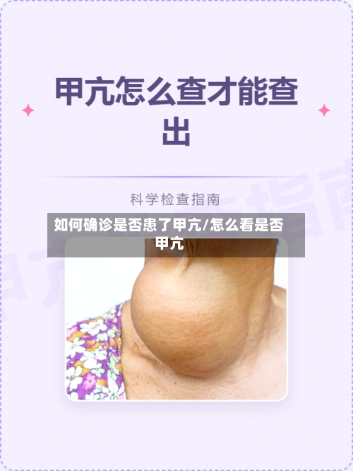 如何确诊是否患了甲亢/怎么看是否甲亢