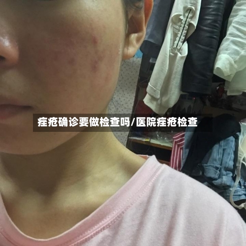 痤疮确诊要做检查吗/医院痤疮检查