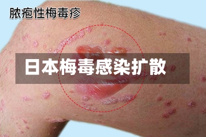 日本梅毒感染扩散