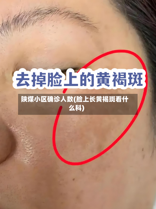 陕煤小区确诊人数(脸上长黄褐斑看什么科)