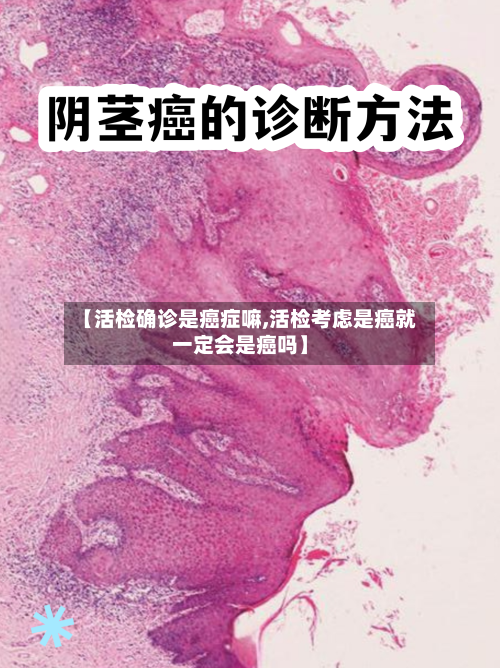 【活检确诊是癌症嘛,活检考虑是癌就一定会是癌吗】
