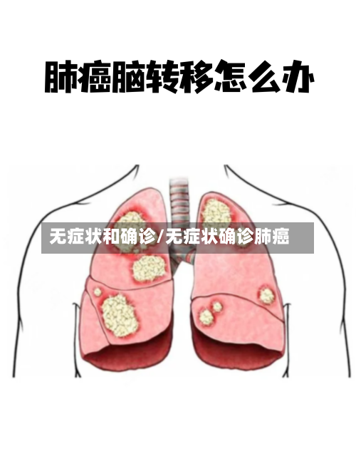 无症状和确诊/无症状确诊肺癌