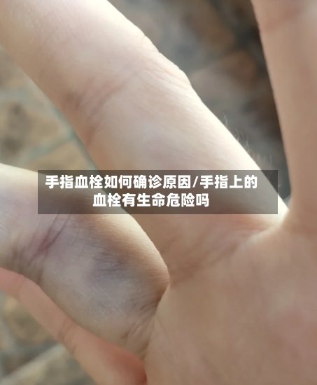 手指血栓如何确诊原因/手指上的血栓有生命危险吗