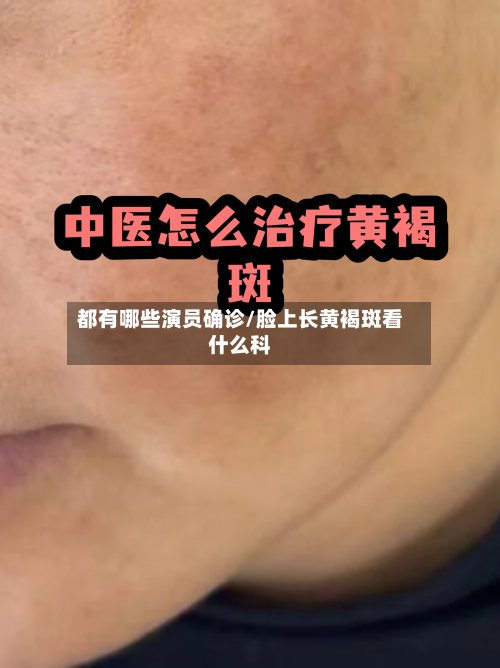 都有哪些演员确诊/脸上长黄褐斑看什么科