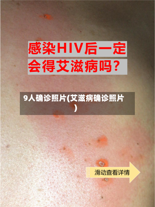 9人确诊照片(艾滋病确诊照片)
