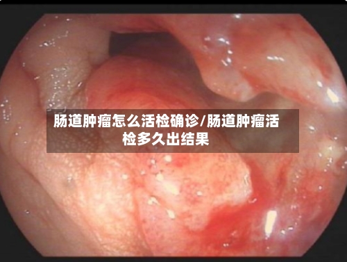肠道肿瘤怎么活检确诊/肠道肿瘤活检多久出结果